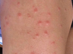 Example of midge bits on skin